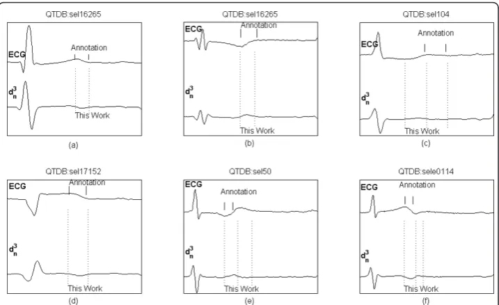 Figure 8 Delineation of T wave. Examples of T waves from QTDB records, with manual annotations (top)and delineated characteristic points (bottom): dominant T peak, dominant T offset, T end