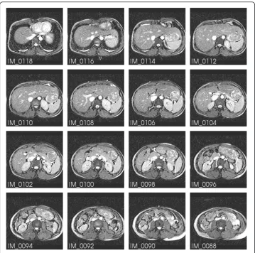 Figure 1 MR image stack of the torso. A subset of the survey series (301). IM_0090 and IM_0108 showthe marker pills used as spatial reference.