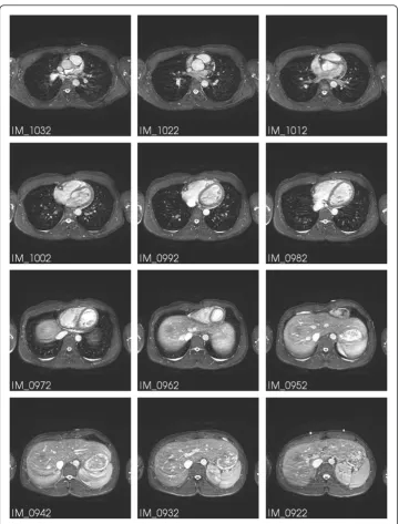 Figure 2 MR image stack of the heart at diastole. A subset of series 701. In IM_0922 the same markersare seen as in IM_0108 of Figure 1.