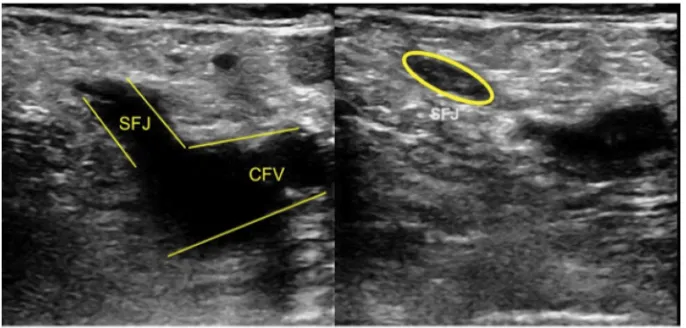Figure 1 Demonstration of superficial venous thrombus at the proximal GSV by venous duplex compression ultrasonography