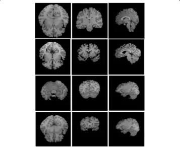 Figure 2 Brain extraction results of four normal T1-weighted MR brain images. Columns from left toright is shown in axial, coronal and sagittal orientations respectively.