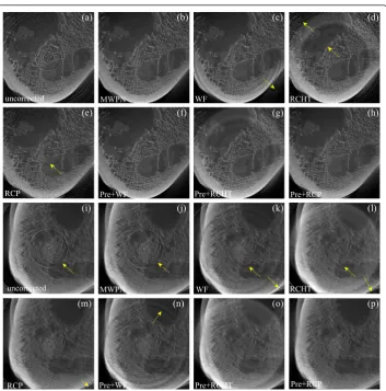 Figure 4 Removal of ring artifacts from the micro-CT and dental-CT images of an animal boneUncorrected bone image from micro-CT machine, (b-e) corrected images by using the MWPN (h) areand RCP methods, respectively