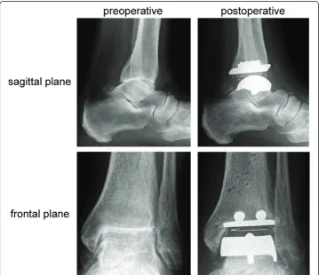 Figure 1 Radiographs of a left arthrotic ankle joint pre-and postoperative in sagittal and frontalplane.