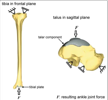 Figure 4 Boundary conditions for the tibia and the talus.