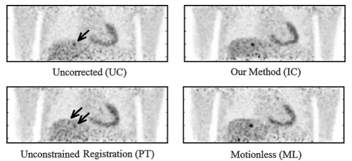 Fig. 11 A case in which image quality deteriorates after unconstrained PET-PET registration based motion correction
