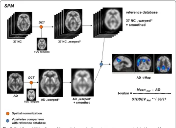 Fig. 1 Workflow of SPM software. After spatial normalization, a t‑map image was calculated by voxel‑by‑voxel single subject comparison to reference database