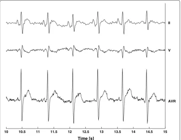 Fig. 2 Example of ECG traces from different recording configurations (leads).