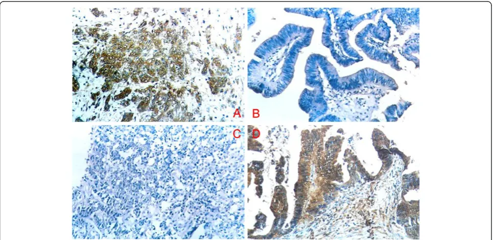 Figure 1 Expression of brain-derived neurotrophic factor (BDNF) and bone morphogenetic protein receptor type IA (BMPR1A)inbenign and malignant gallbladder lesions