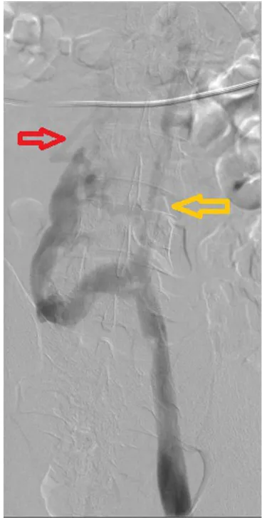 Figure 4 Lower extremity venogram. Interrupted IVC (yellow arrow) and lower extremity drained by hemiazygos veins (red arrow).Abbreviation: IVC, inferior vena cava.