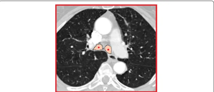 Figure 4 Example of “masking” as it appears on a sagittal slice. Half trachea label is used to turn values where the half trachea overlays to 0 HU (grey voxels)