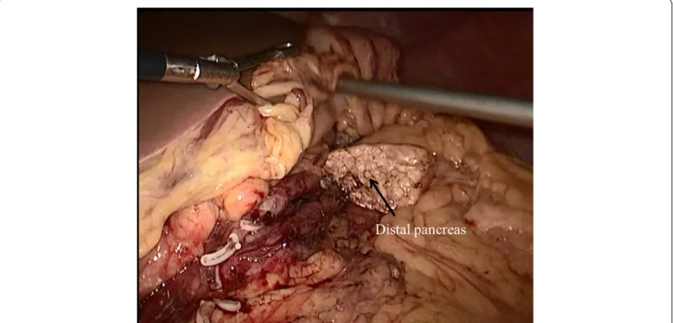 Figure 2 Pancreas dissection and transection performed by laparoscopic central pancreatectomy.