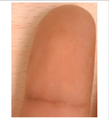 Figure 8 Fingerprint image acquired using mobile phone camera.