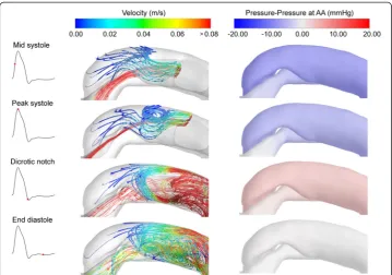 Figure 5 Flow characteristics in the proximal FL. Left column shows streamlines calculated from the‘Proximal’ plane in the FL (see Figure 4)
