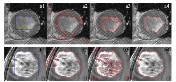 Figure 7 Comparison of our method with GCV and LBF model in the segmentation of the two MRimages in (a1) and (b1), respectively