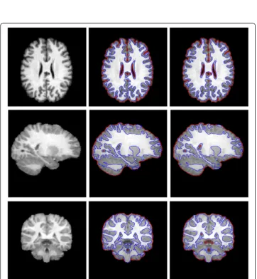 Figure 8 Application of our method in segmenting the 3T MR images. (a) original images and initial bluecontours, (b) (c) (d) (e) segmentation results of ε is set to 0.1, 0.3, 0.5, 0.8, respectively