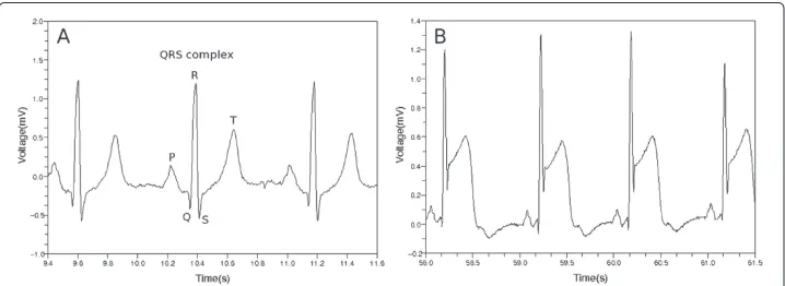 Figure 1 Normal ECG and ST segment elevation. (a) Normal ECG is divided into P, Q, R, S and T parts
