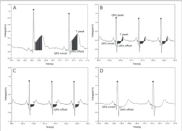 Figure 5 Features used in the classification process. Area between QRS offset and T peak with respect tothe reference mean voltage fecg (QRS onset) in cases of (a) ST segment elevation and (b) ST segmentdepression