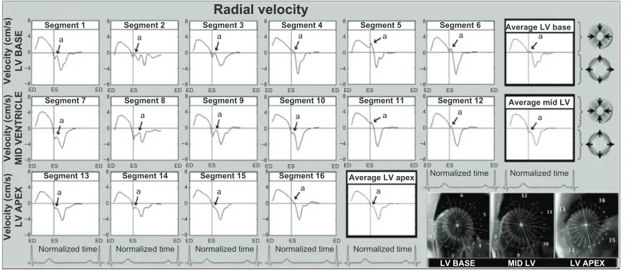 Figure 2 Radial velocity graphs for individual left ventricular segments (American Heart Association segmentation model) during a cardiac cycle, showing the influence of reflected aortic pressure waves on radial motion in early diastole
