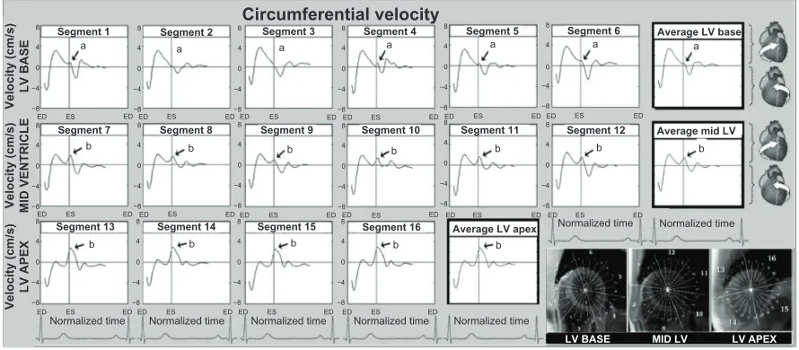 Figure 3 Longitudinal velocity graphs for individual left ventricular segments (American Heart Association segmentation model) showing the influence of reflected aortic pressure waves on longitudinal motion in early diastole