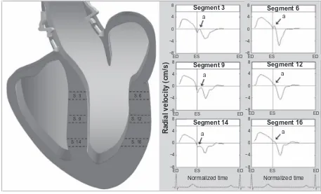 Figure 5 Schematic representation of the effect of reflected wave propagation on ventricular segments, demonstrating a greater influence of reflected aortic pressures waves on septal segments which are in continuity with the aorta, compared with lateral se