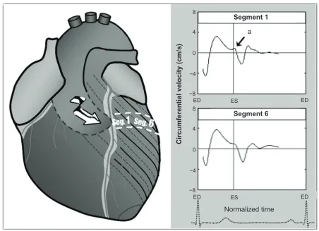 Figure 6 The brief notch of clockwise rotation (a) in the anterior ventricular segments could be explained by potential propagation of the reflected wave on these segments, given the orientation of the aortic arch
