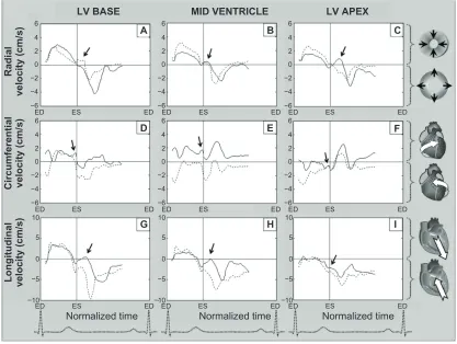 Figure 7 Radial, circumferential, and longitudinal velocity graphs obtained in a patient with a left ventricular scar (solid line) and in a subject with ischemic heart disease likely representing amplification of reflected wave on scar tissue.Abbreviations