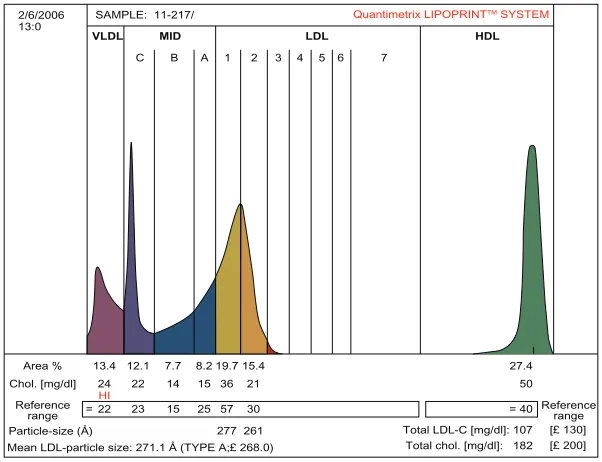 Figure 2 The densitometric scan of LDL subfractions (Pattern B) obtained in patients with sLe.