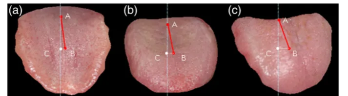 Figure 7 The tongue images of 3 TIA patients respectively with deviation angles = 4.3, 6.3, and 6.6degrees.