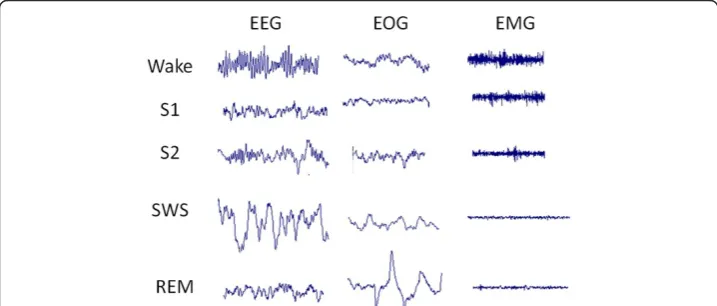 Figure 1 Typical polygraphic recordings during the wake (WK), stage 1 (S1), stage 2 (S2) light sleep,slow-wave sleep (SWS) associated with deep sleep, and rapid-eye movement (REM) states
