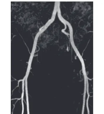 Figure 4 Maximum Intensity Projection (MIP) of the MRA dataset for common iliac artery.