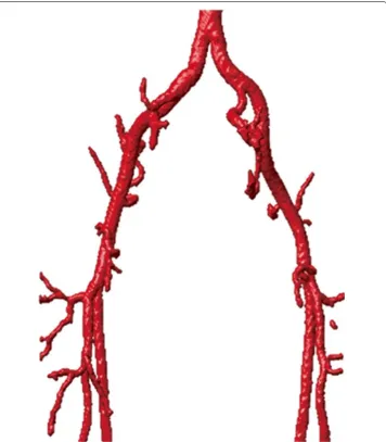 Figure 5 3D vascular tree of the segmentation result on iliac artery MRA dataset using the proposedlocalized hybrid technique.
