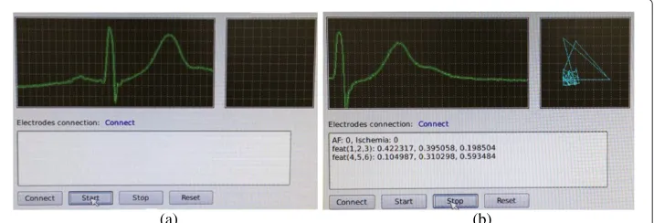 Figure 6 Implemented software. Real-time ECG monitoring on human subject. (a) Input ECG signals arevisualized in the main view