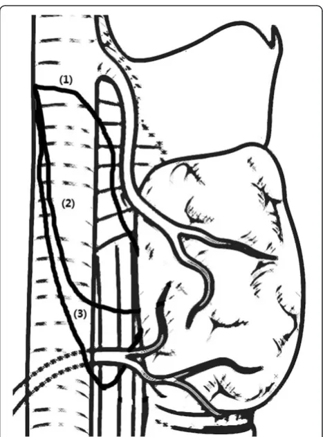 Figure 1 Three types of nonrecurrent laryngeal nerve (NRLN) asdescribed in the literature and based primarily on the coursethe nerve travels.