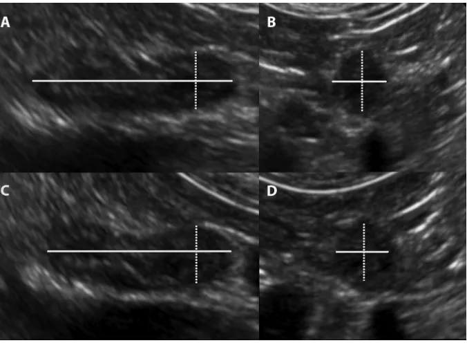 Figure 1 Ultrasound images demonstrating the image plane and location of adrenal gland measurements.Notes: (A) Dorsal recumbency longitudinal image plane: ultrasound image demonstrating the locations of the length (solid line) and CPT or height (dotted lin