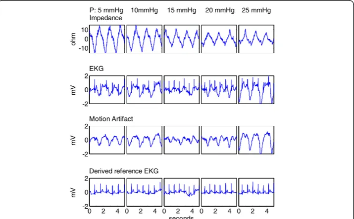 Figure 8 Measured impedance change, ECG and motion artifact, and the derived chest ECG at20 mmHg applied pressure