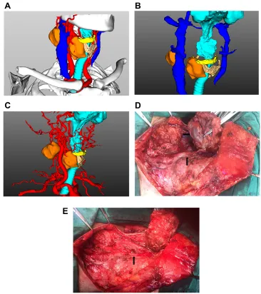Figure 1 (A–C) Three-dimensional (3D) reconstruction images revealed that the tumor invaded into the right internal jugular vein and the right side of the thyroid cartilage and hyoid bone