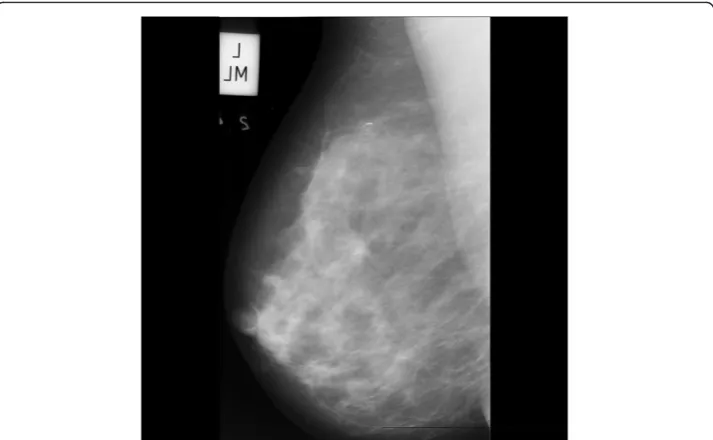 Figure 2 Typical mammogram in MLO view from MIAS. The mammograms show micro-calcifications inthe upper quadrant of the left breast.
