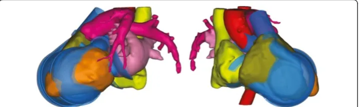 Figure 3 Left and right chamber with adapted in and outlet configurations superimposed toanatomical structures of female patient number 14 (mcs group).
