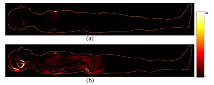 Figure 1 Current density distribution (A/m2) within patient’s body (mid-sagittal section) resulted bythe FDTD analysis: (a) with a non-conductive operating table; (b) with a conductive operating tableconsidered at ground potential