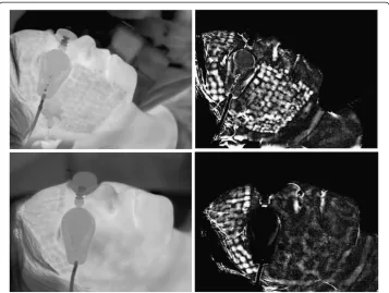 Figure 7 Intermediate results obtained using the algorithm that automatically recognizes ROI andskin areas subjected to laser intervention