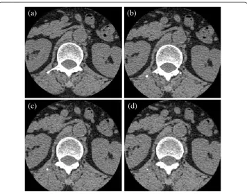 Figure 5 Comparisons of the LBF model and the proposed ERBLS model on segmenting fivecontours by using Otsu threshold; ColumnColumnvertebra CT images with the intensity inhomogeneity