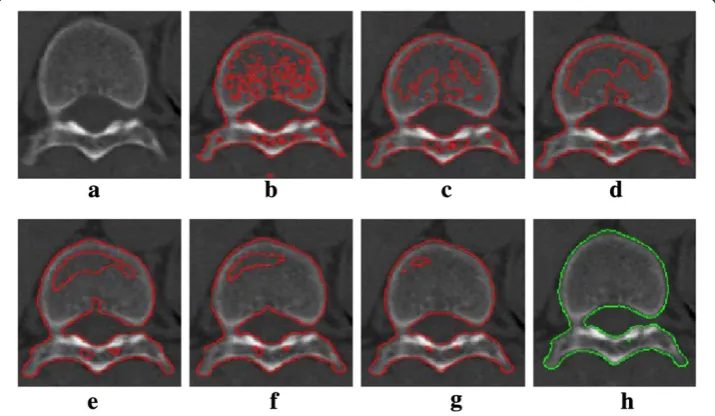 Figure 2 Automatic initialization by Otsu threshold. (a) original image; (b) histogram; (c) initializedimage by Otsu threshold.