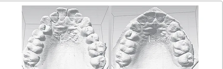Figure 1 Orthodontic measurement of the distance 3-3 using a digital picture of a plaster cast beforeand after treatment.