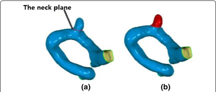 Figure 3 The neck cutting plane and the aneurysm sac separated from the parent vessel