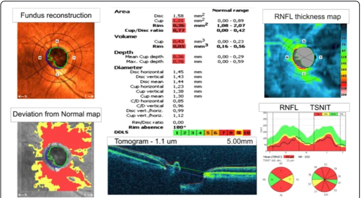 Figure 2 The result for one patient obtained from the Copernicus tomograph.can be seen in the corners: fundus reconstruction, a deviation from the normal map, the RNFL thicknessmap and the graph RNFL TSNIT
