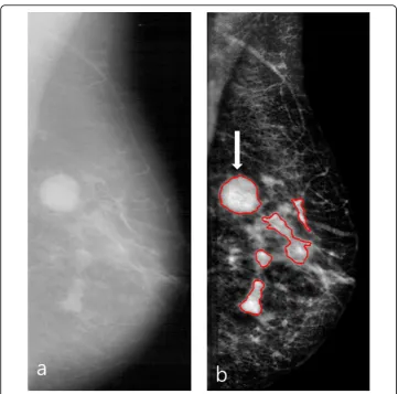 Figure 2 An example of the enhanced mammogram and segmented ROIs. (a) A mammogram fromDDSM DB