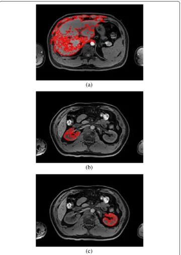 Figure 4 Region growing algorithm, (a) liver; (b) right kidney; (c) left kidney.