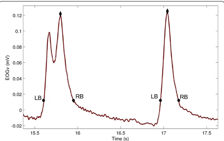 Figure 6 Double-peaked blink. Example of a double-peaked (left) and normal blink (right)