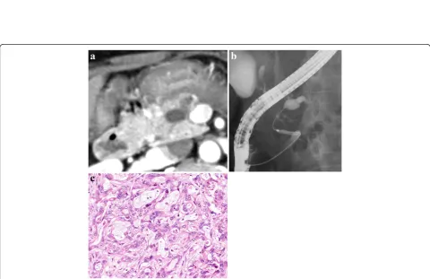 Figure 1 Abdominal computed tomography (CT), endoscopic retrograde cholangiopancreatography (ERCP), and histological findingsof the first pancreatic cancer