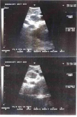 Figure 4.6 C Sequential endoluininal ultrasound images